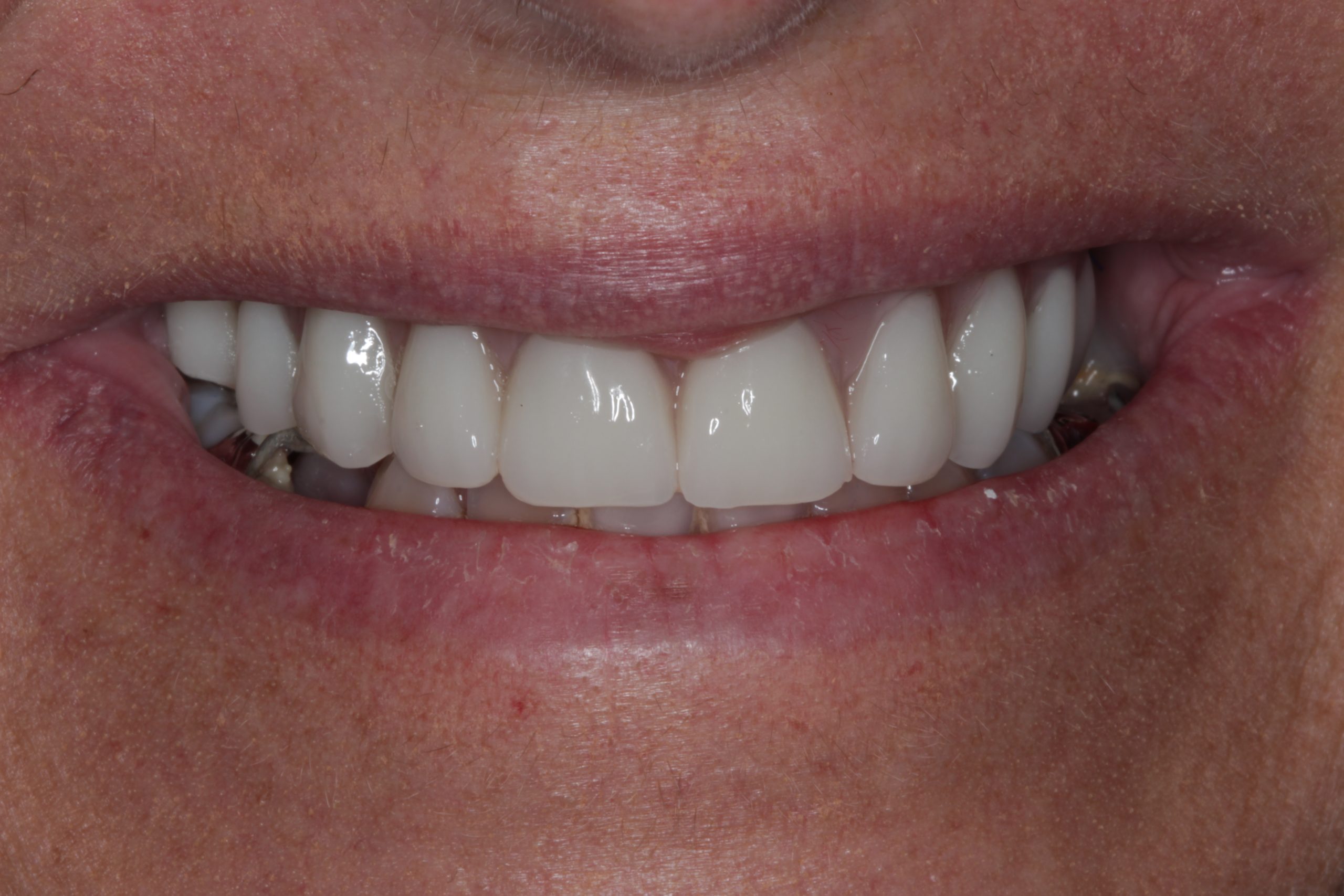 After-frontal-scaled