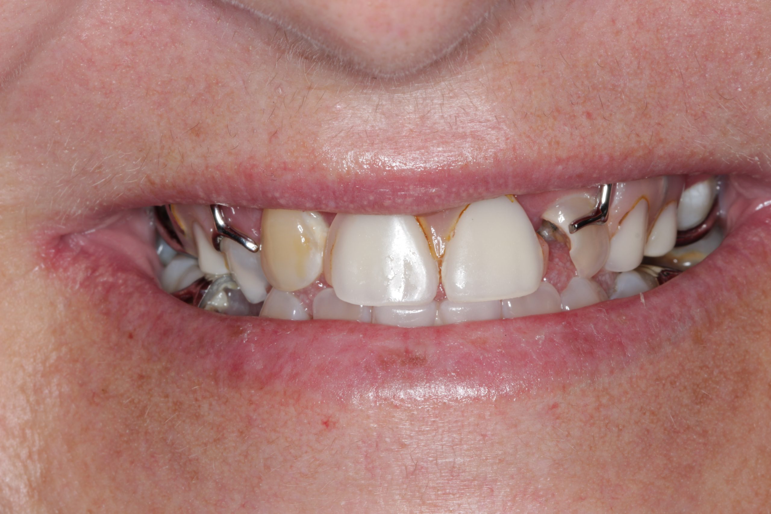 Before-Frontal-scaled Before-Frontal-scaled