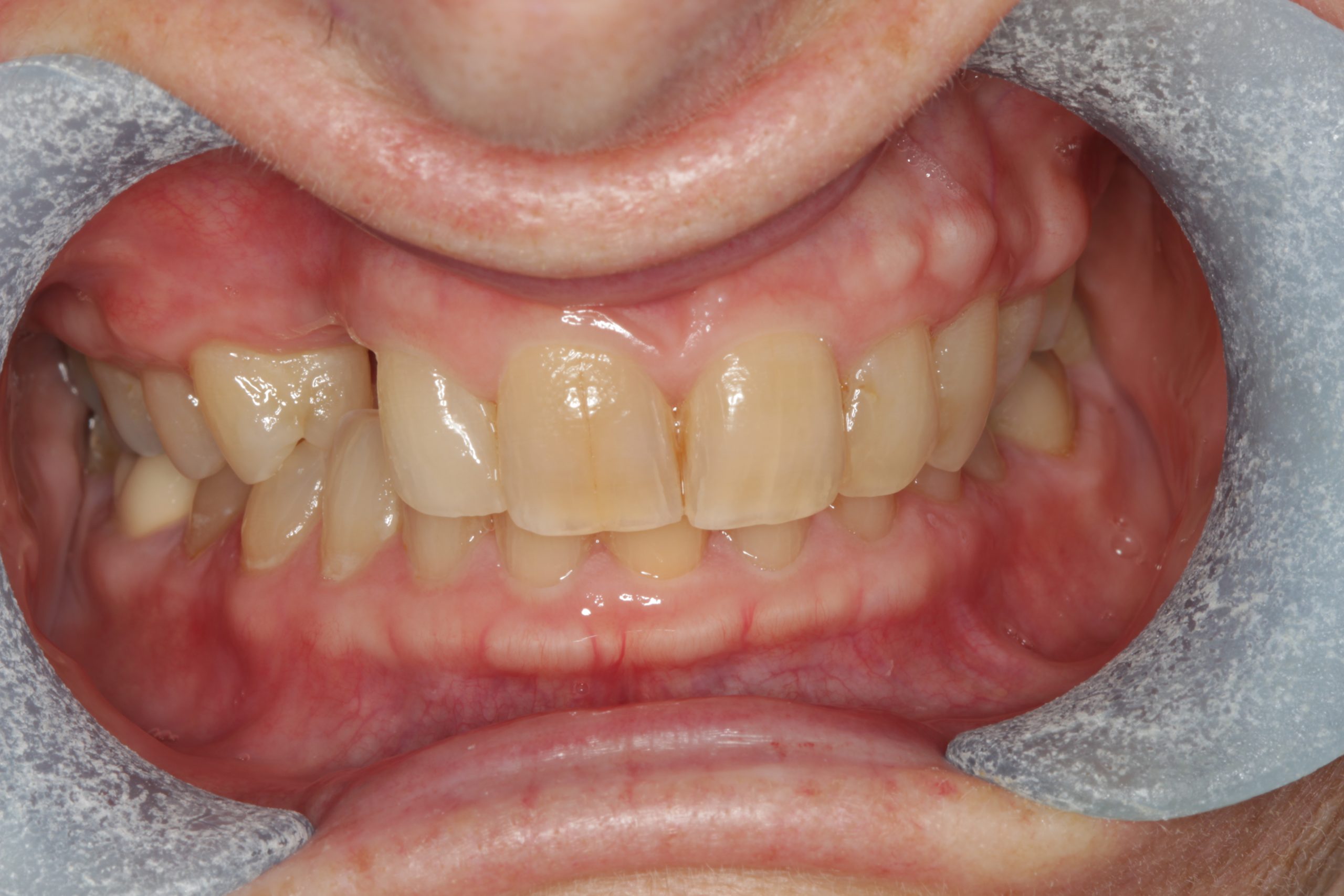 Before-frontal-retracted-scaled Before-frontal-retracted-scaled