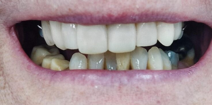 composite-bonding-1-after