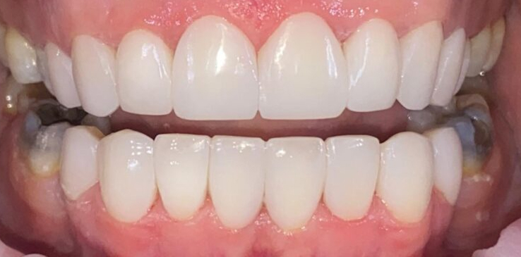 composite-bonding-1-after