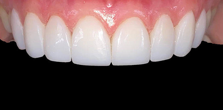 composite-bonding-1-after