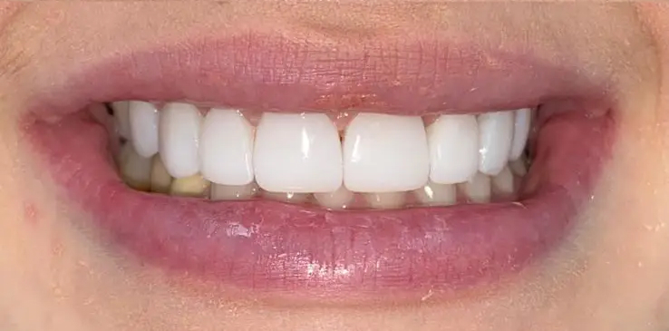 composite-bonding-1-after