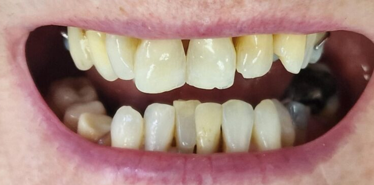 composite-bonding-1-before composite-bonding-1-before