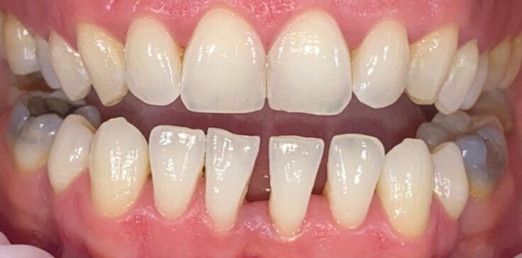 composite-bonding-1-before composite-bonding-1-before