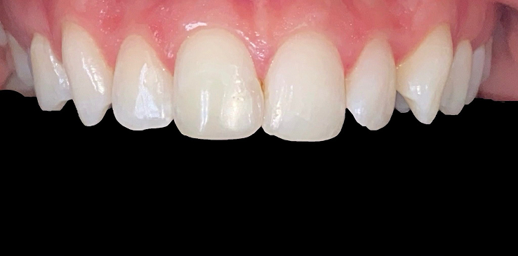 composite-bonding-1-before composite-bonding-1-before