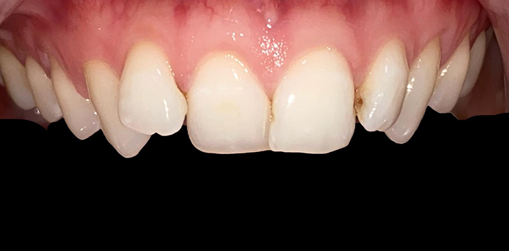 composite-bonding-1-before composite-bonding-1-before