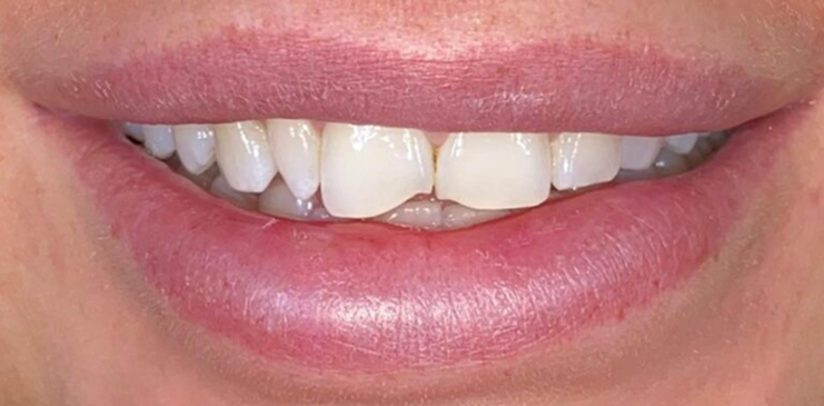 composite-bonding-1-before composite-bonding-1-before