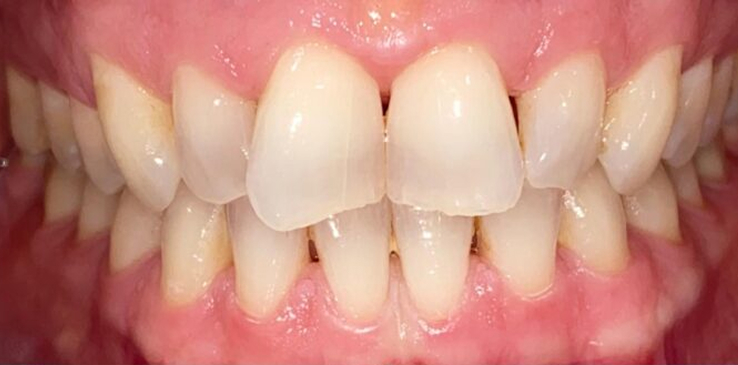 composite-bonding-1-before composite-bonding-1-before