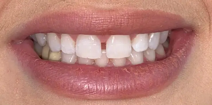 composite-bonding-1-before composite-bonding-1-before