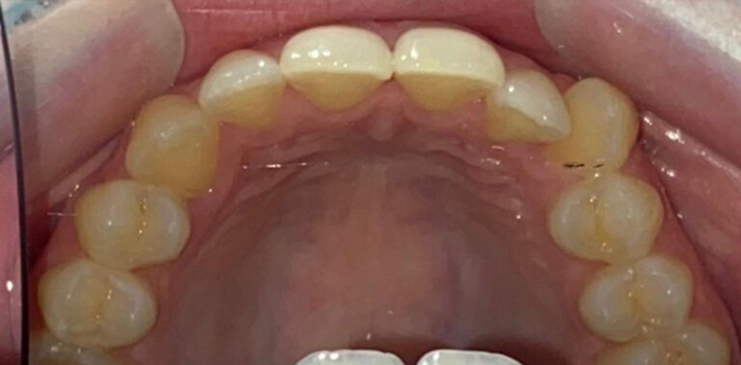 invisalign-before invisalign-before