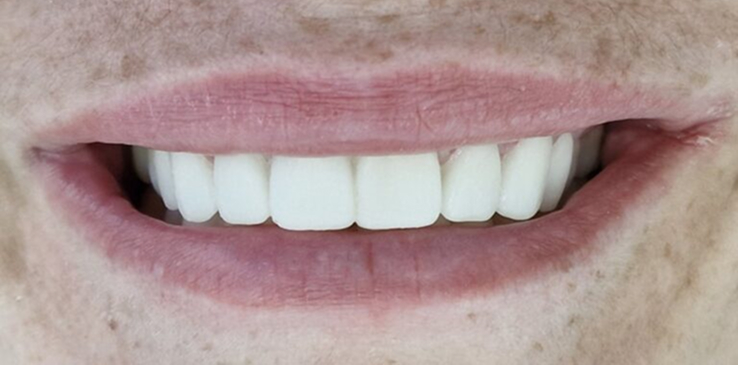 porcelain-veneers-after