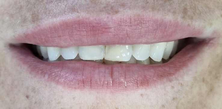 porcelain-veneers-before porcelain-veneers-before