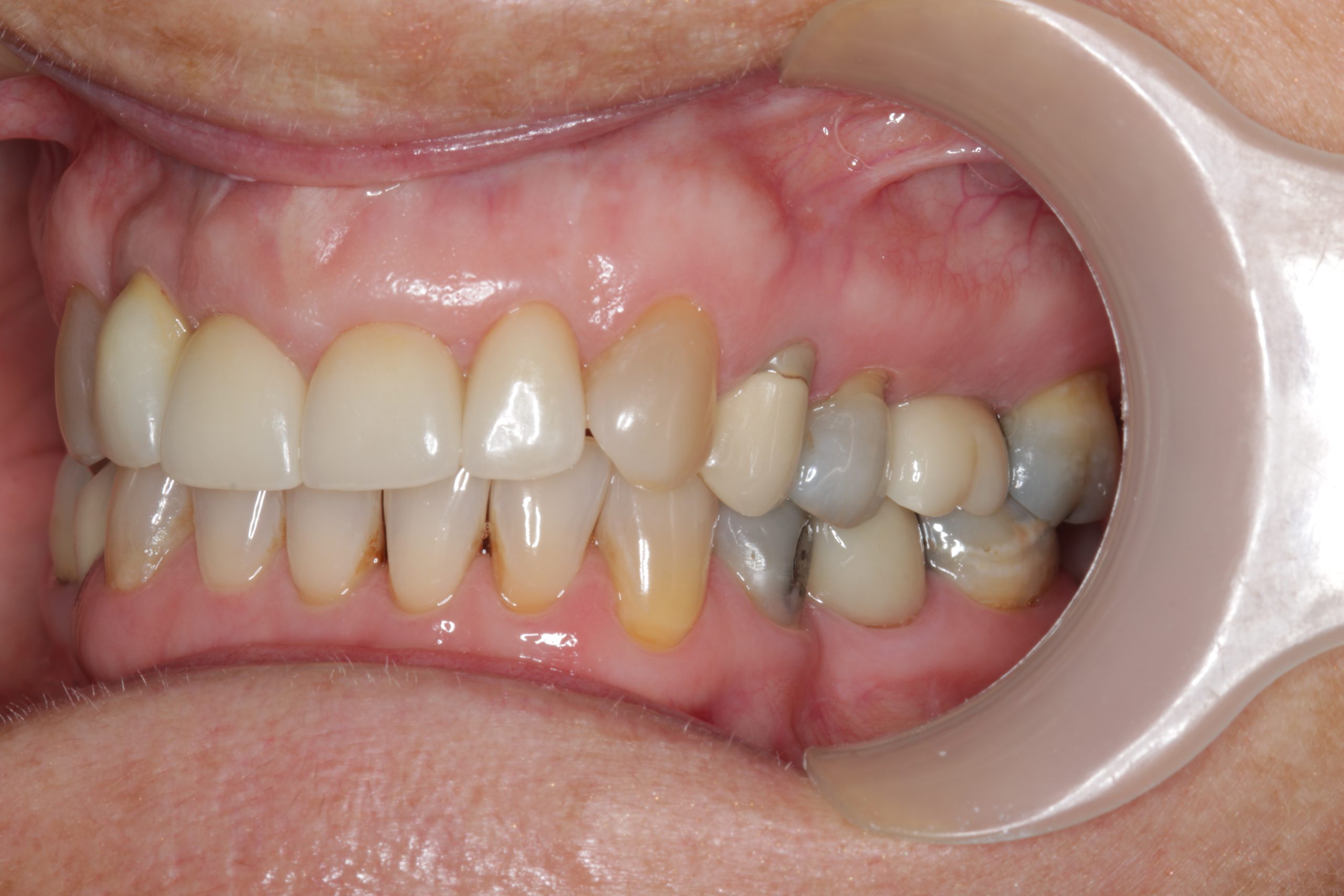 side-view-after--scaled